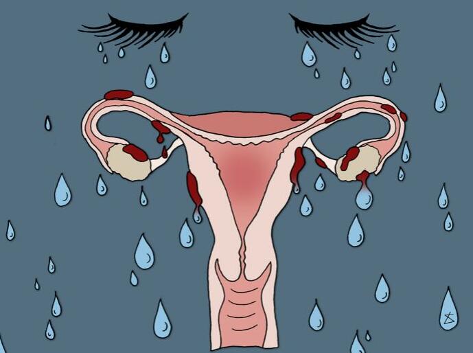 子宫内膜异位有哪些症状？对于生育有哪些影响？