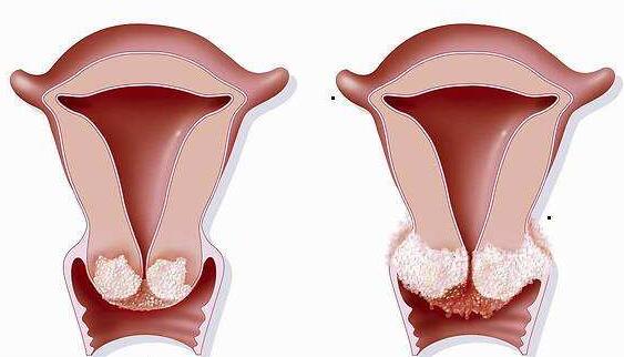 乳头瘤病毒阳性对于女性怀孕有影响吗？有什么需要注意的？